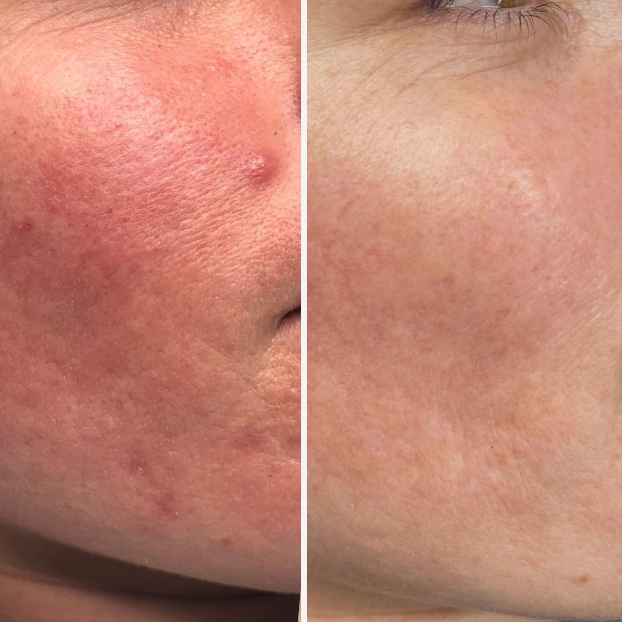 skin needling before and after
